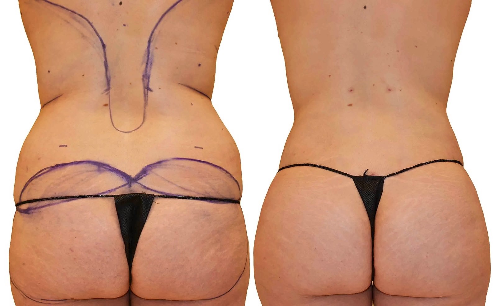 Before/After Fat Transfer, BBL before and after, actual patient of Dr. Long