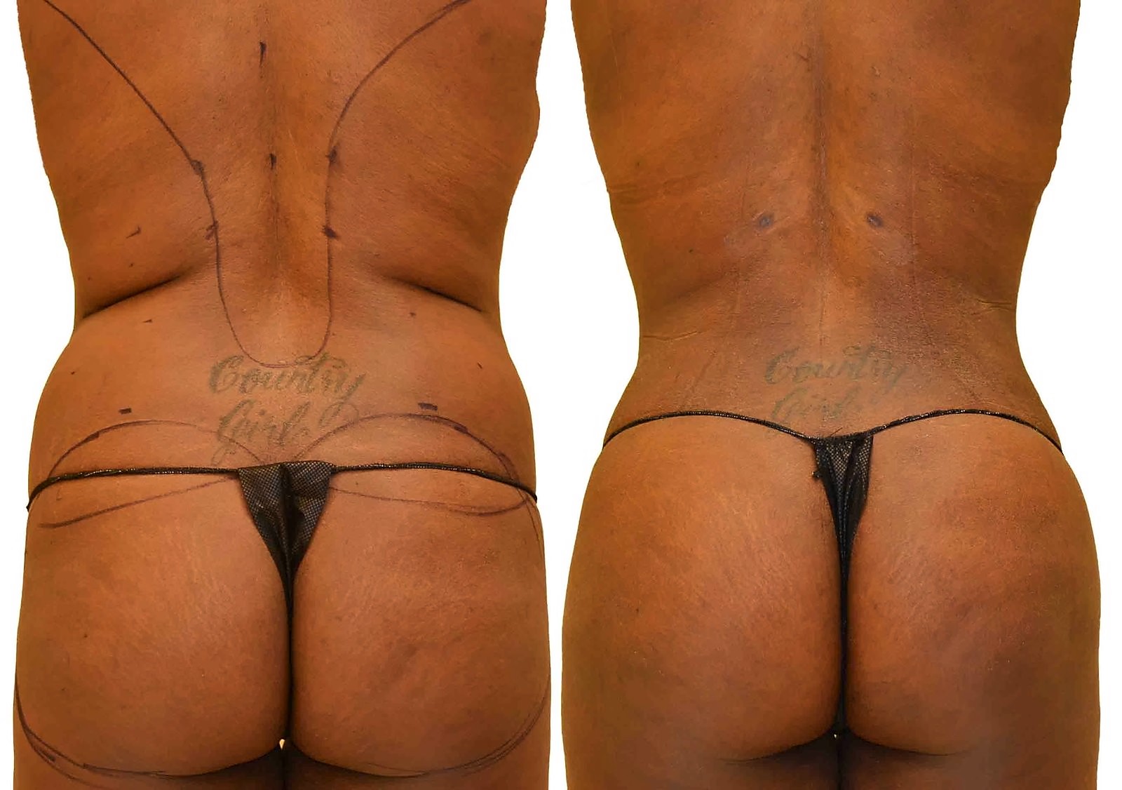 Before/After Fat Transfer, BBL before and after, actual patient of Dr. Long