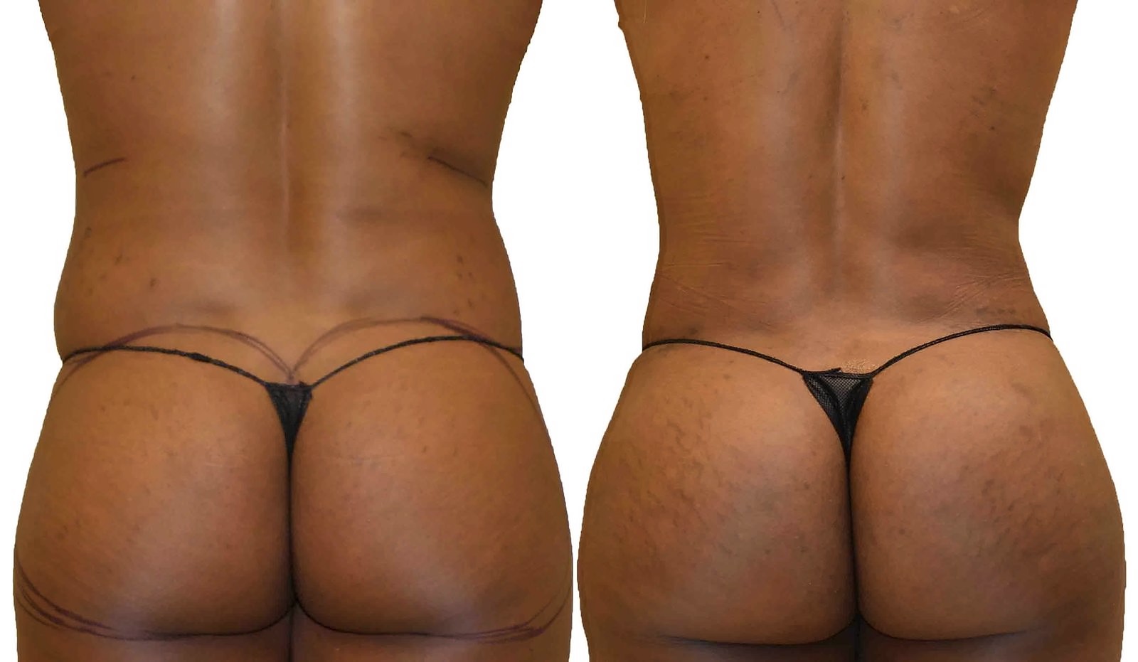 Before/After Fat Transfer, BBL before and after, actual patient of Dr. Long
