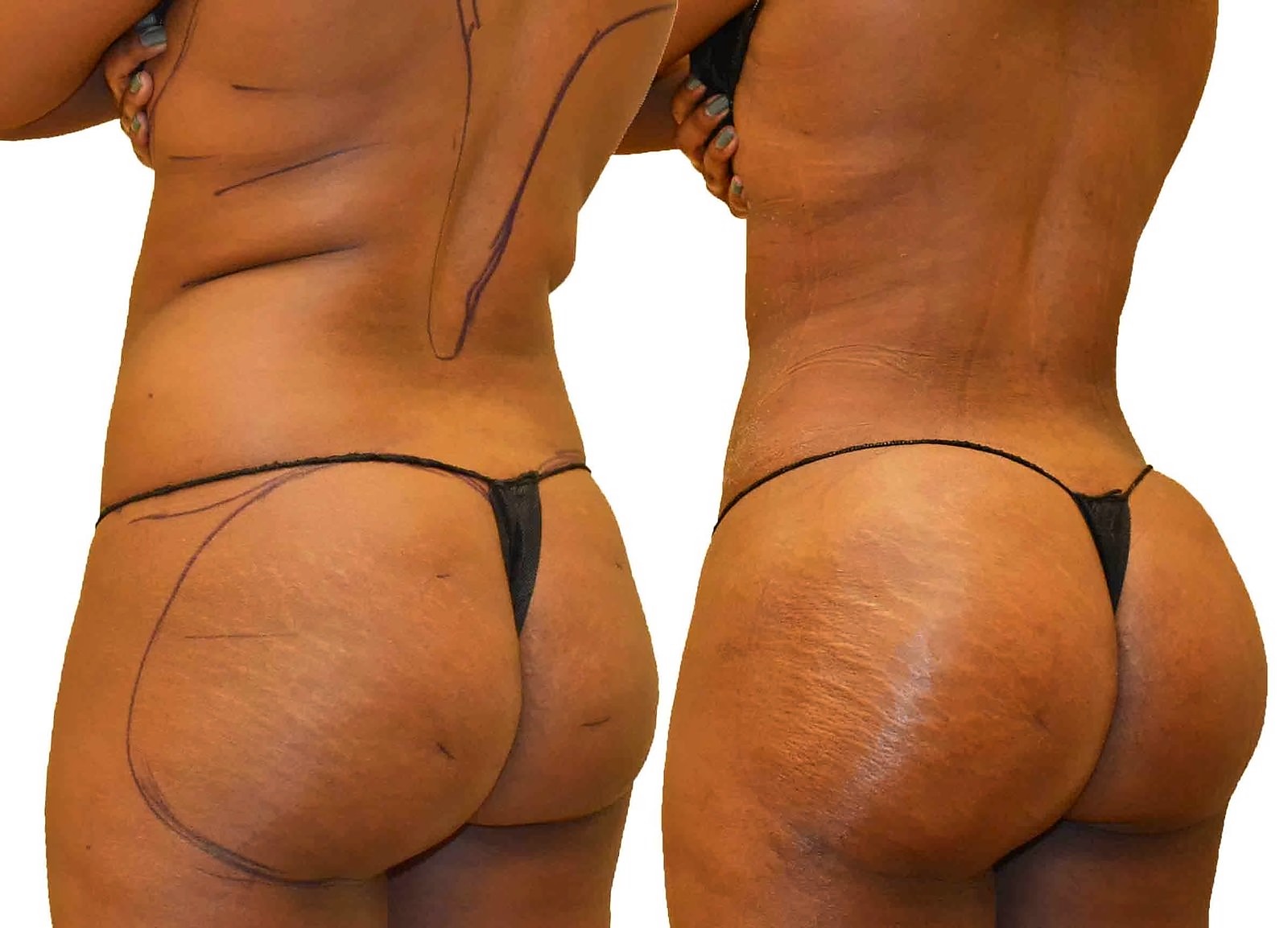 Before/After Fat Transfer, BBL before and after, actual patient of Dr. Long