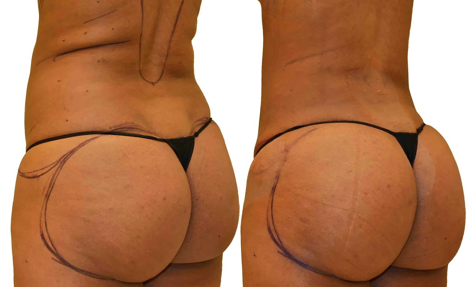 Before/After Fat Transfer, BBL before and after, actual patient of Dr. Long