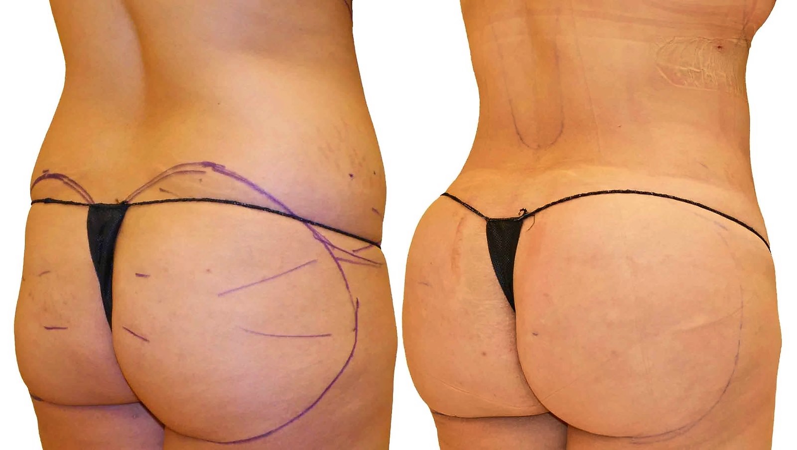 Before/After Fat Transfer, BBL before and after, actual patient of Dr. Long