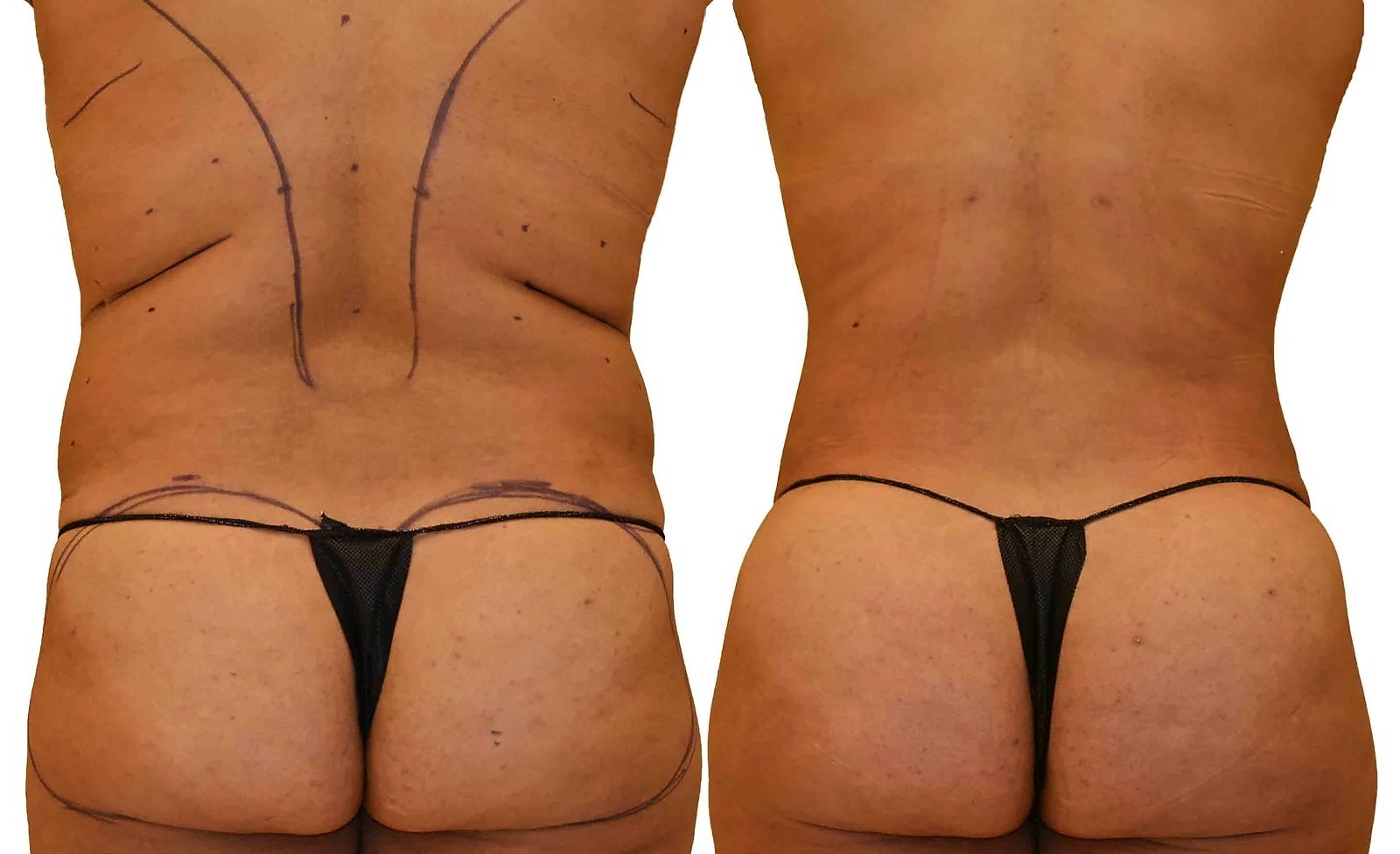 Before/After Fat Transfer, BBL before and after, actual patient of Dr. Long