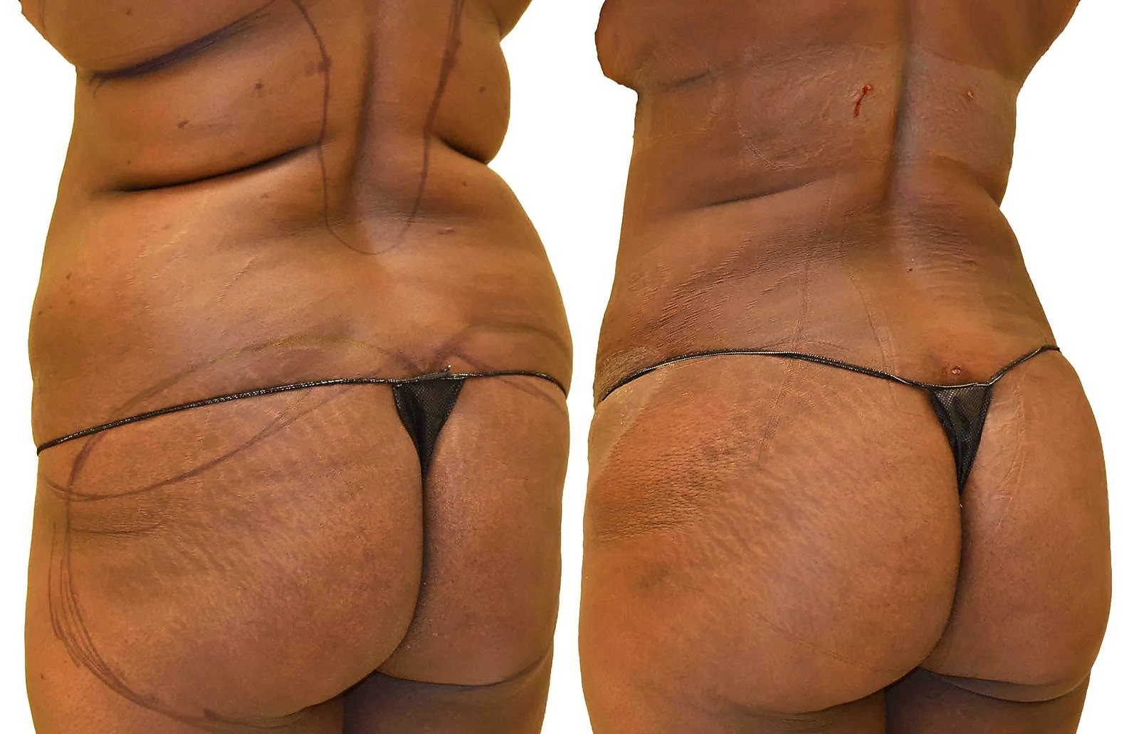 Before/After Fat Transfer, BBL before and after, actual patient of Dr. Long