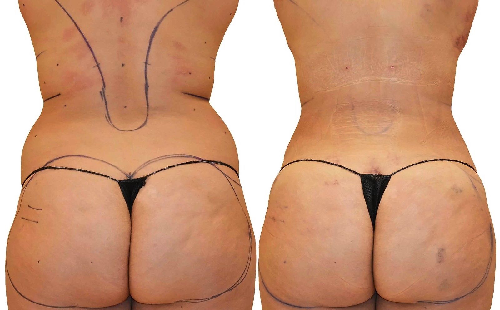 Before/After Fat Transfer, BBL before and after, actual patient of Dr. Long