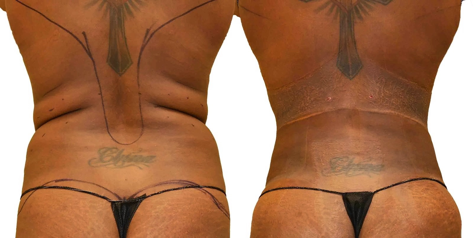 Before/After Fat Transfer, BBL before and after, actual patient of Dr. Long