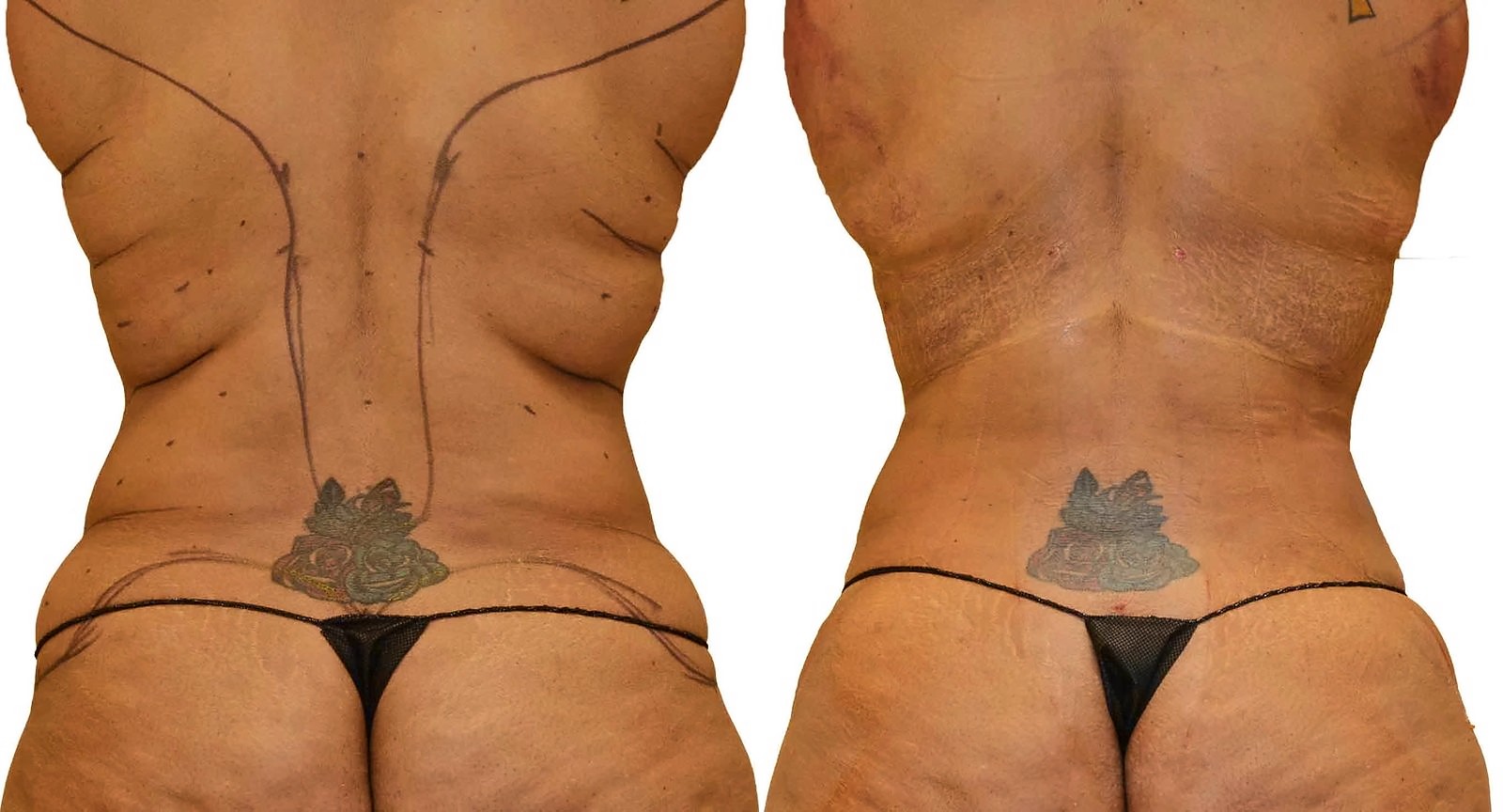 Before/After Fat Transfer, BBL before and after, actual patient of Dr. Long
