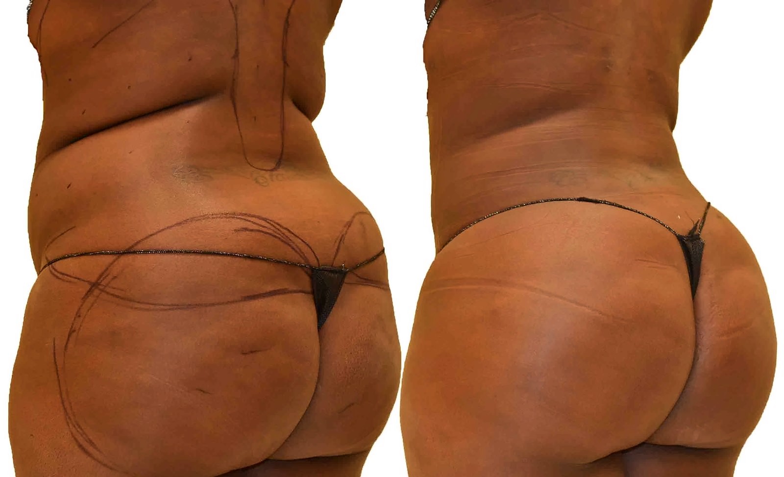 Before/After Fat Transfer, BBL before and after, actual patient of Dr. Long