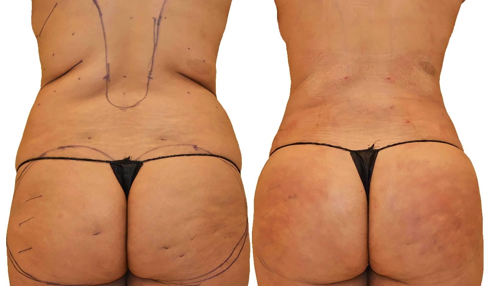 Before/After Fat Transfer, BBL before and after, actual patient of Dr. Long