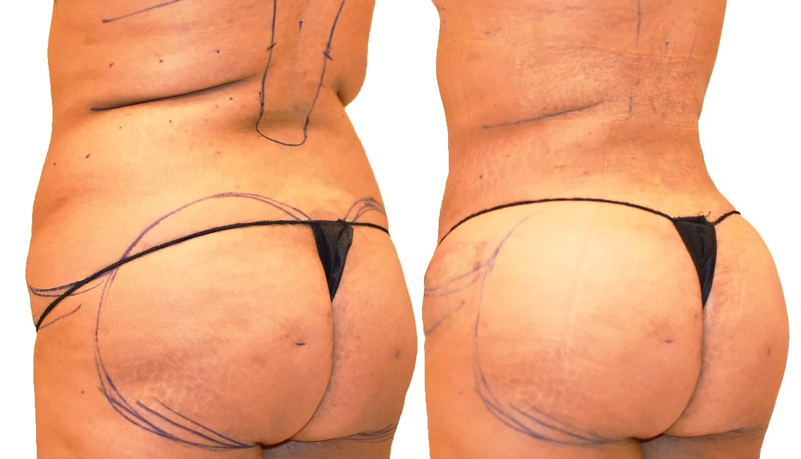 Before/After Fat Transfer, BBL before and after, actual patient of Dr. Long