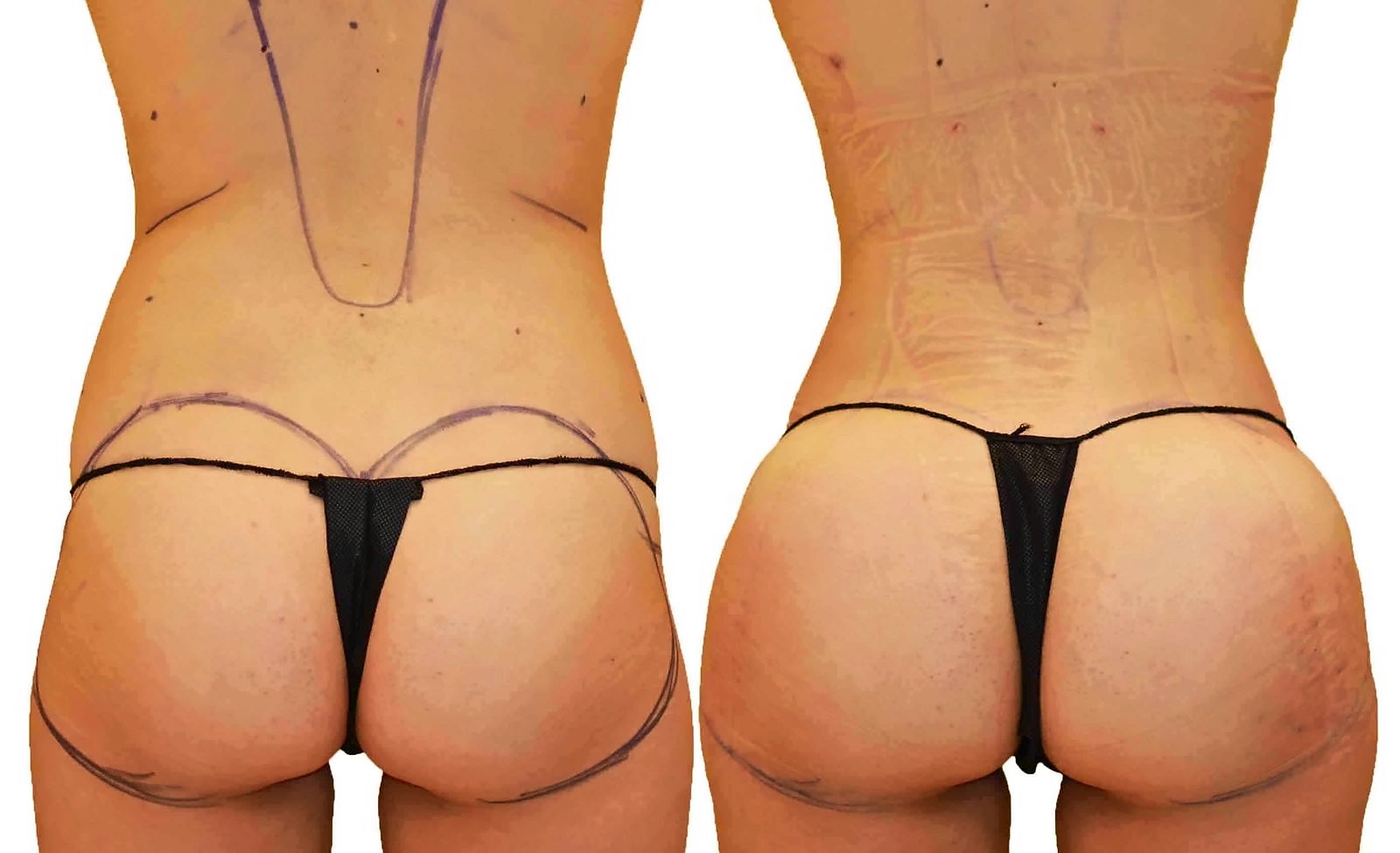 Before/After Fat Transfer, BBL before and after, actual patient of Dr. Long