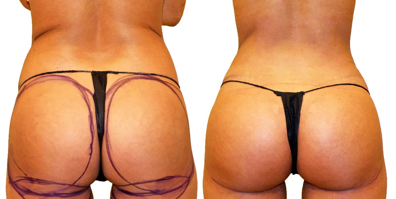 Before/After Fat Transfer, BBL before and after, actual patient of Dr. Long