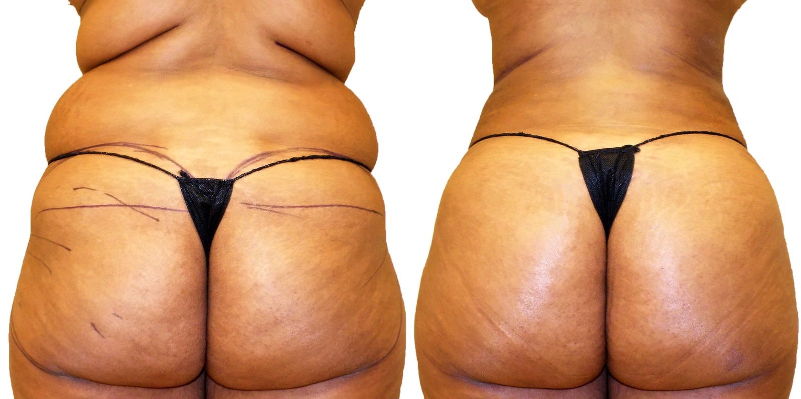 Before/After Fat Transfer, BBL before and after, actual patient of Dr. Long