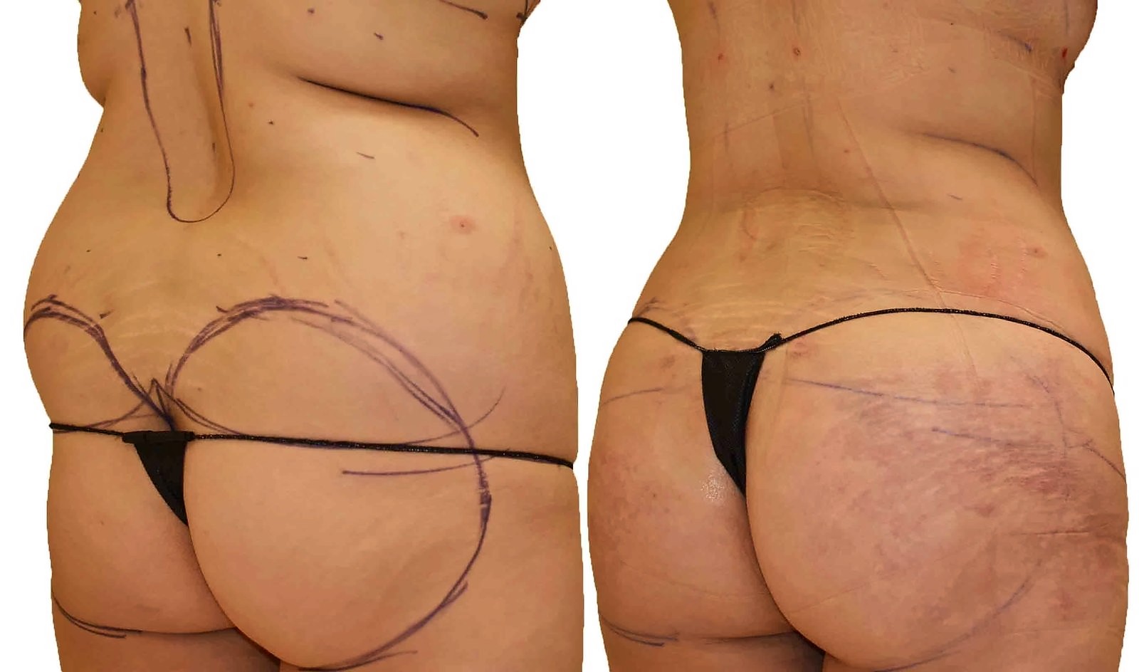 Before/After Fat Transfer, BBL before and after, actual patient of Dr. Long