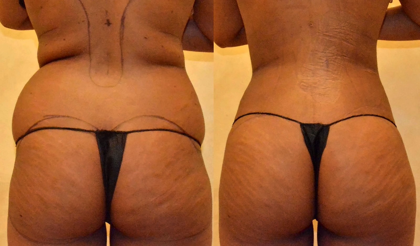 Before/After Fat Transfer, BBL before and after, actual patient of Dr. Long