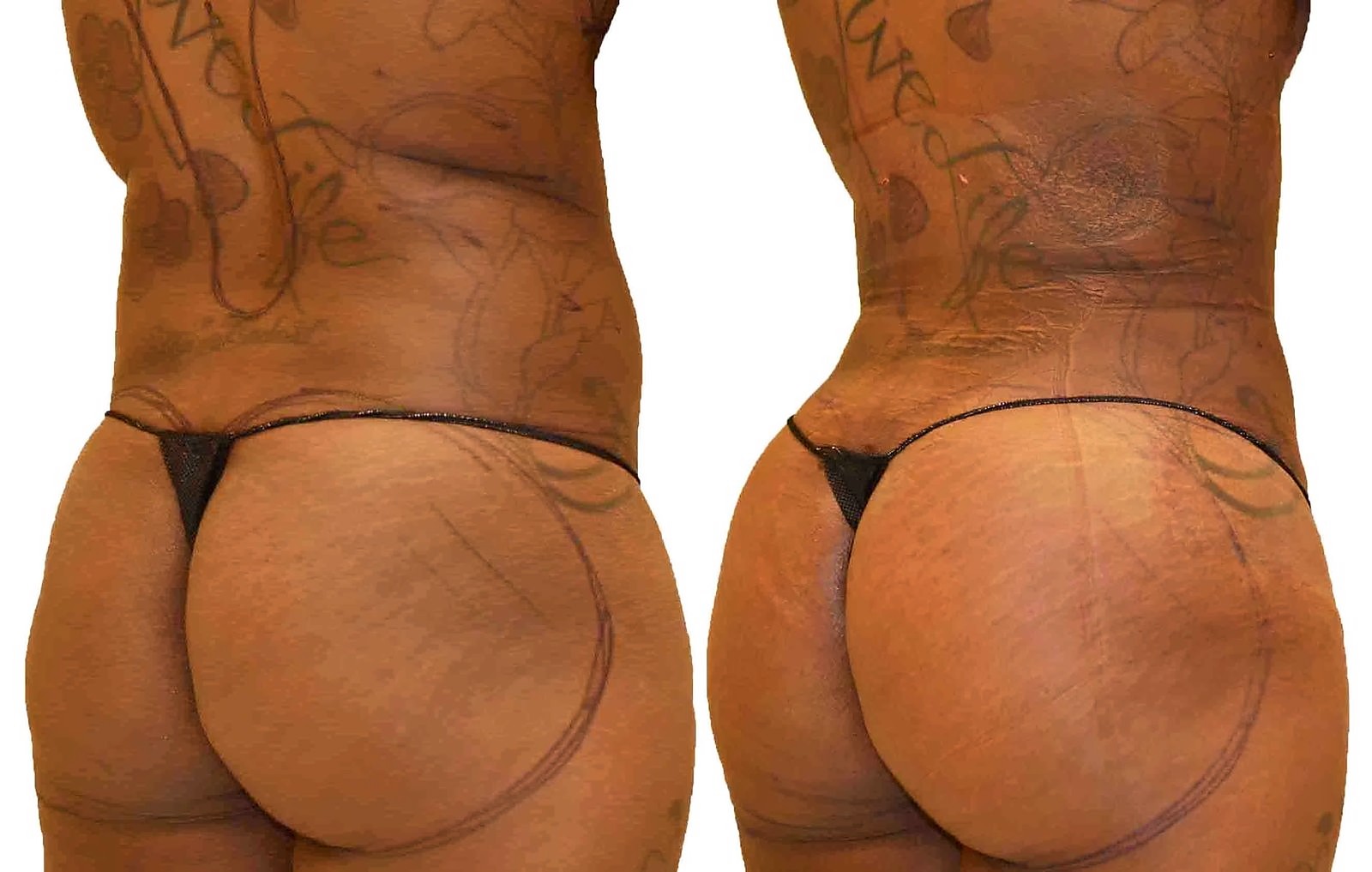 Before/After Fat Transfer, BBL before and after, actual patient of Dr. Long