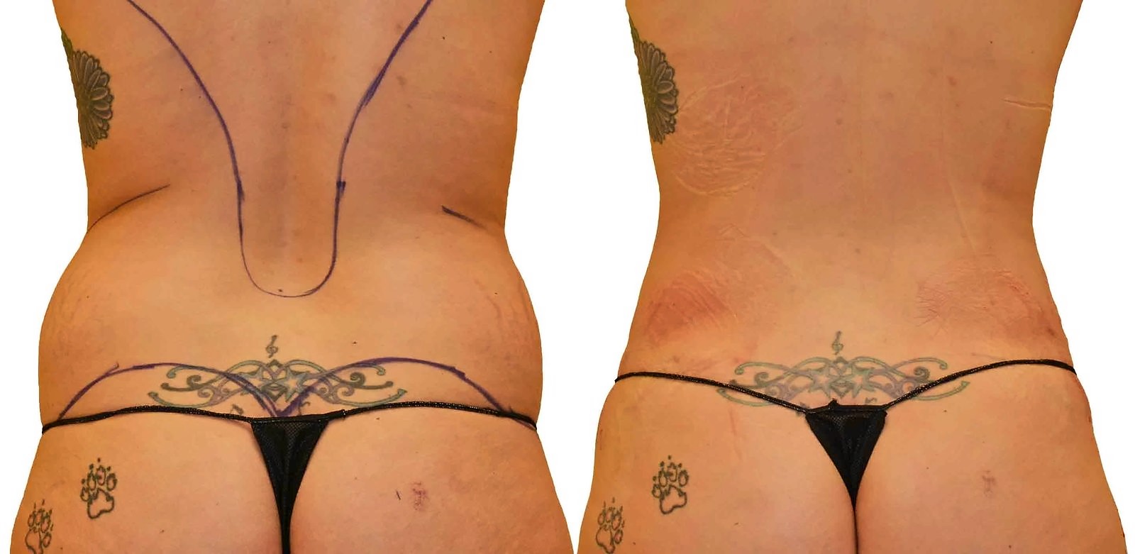 Before/After Fat Transfer, BBL before and after, actual patient of Dr. Long