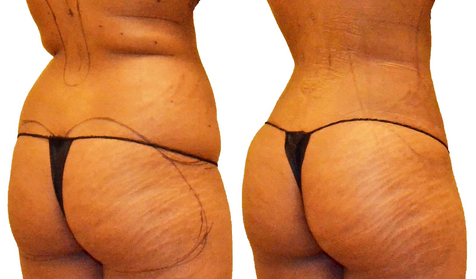 Before/After Fat Transfer, BBL before and after, actual patient of Dr. Long