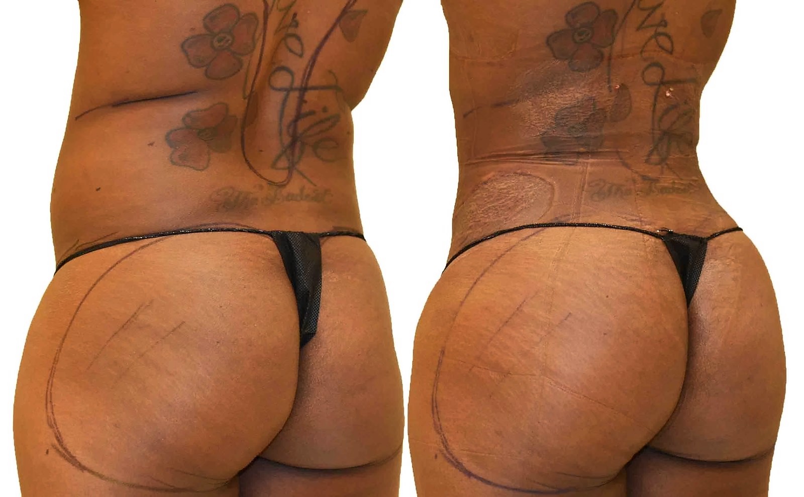 Before/After Fat Transfer, BBL before and after, actual patient of Dr. Long
