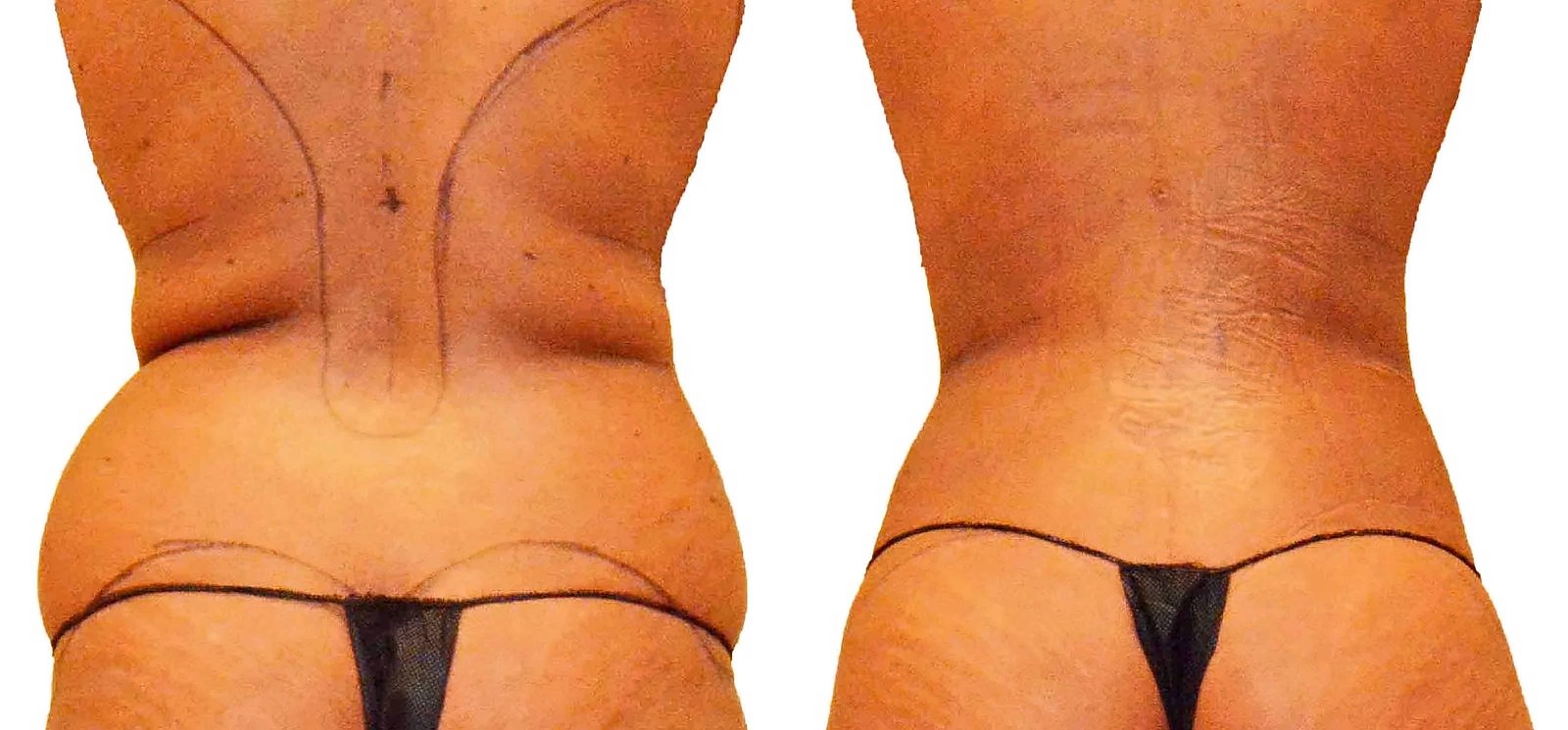 Before/After Fat Transfer, BBL before and after, actual patient of Dr. Long