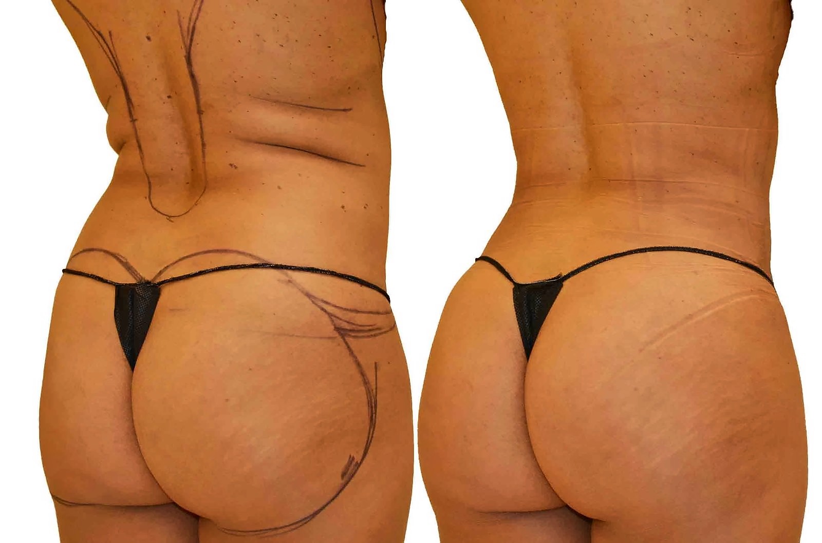 Before/After Fat Transfer, BBL before and after, actual patient of Dr. Long