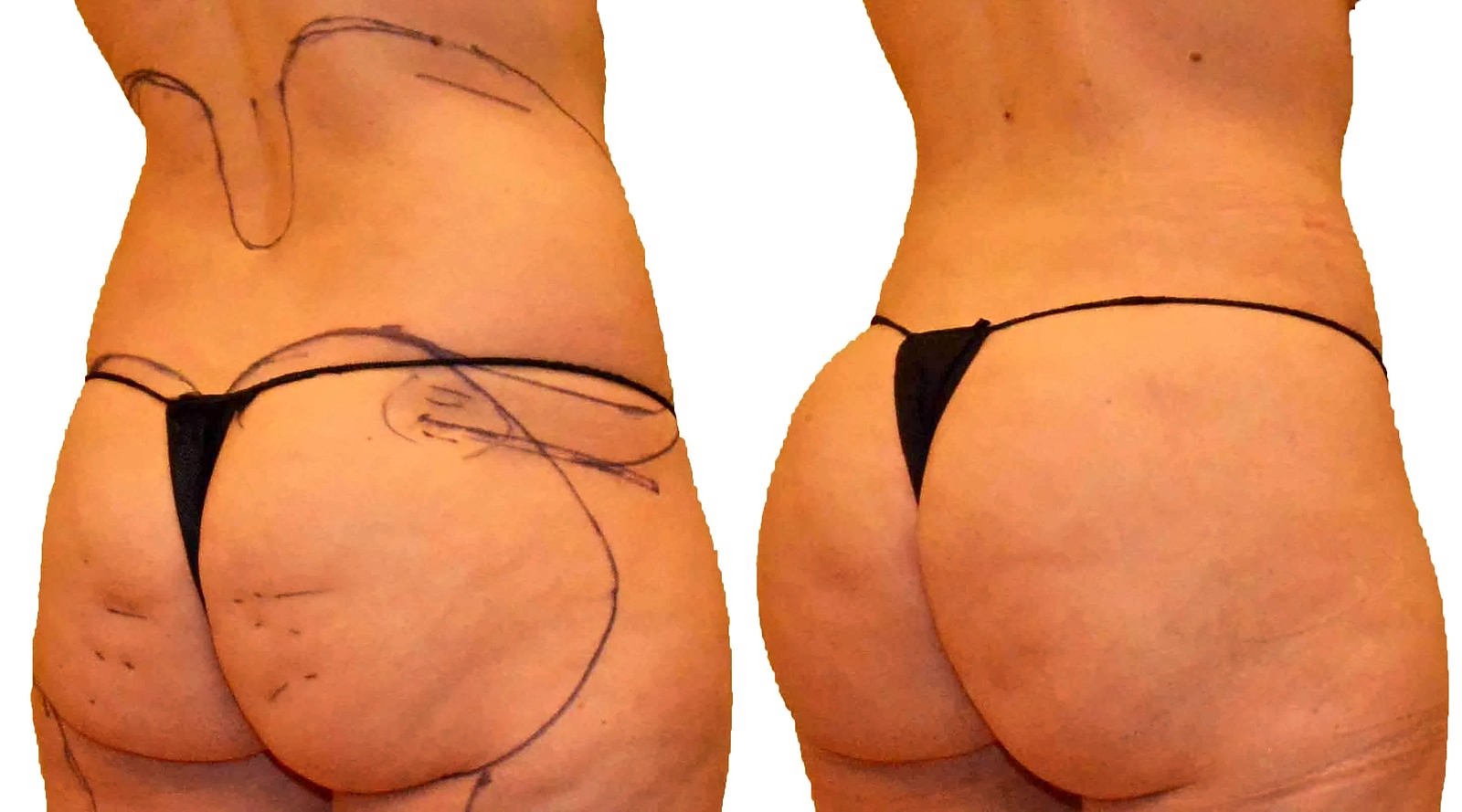 Before/After Fat Transfer, BBL before and after, actual patient of Dr. Long