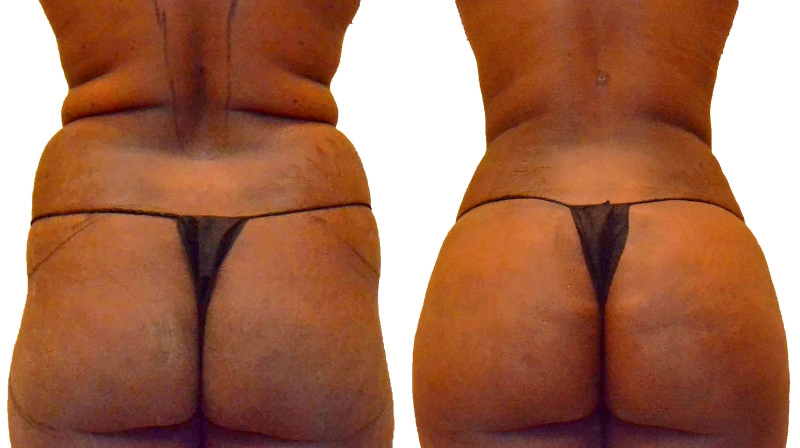 Before/After Fat Transfer, BBL before and after, actual patient of Dr. Long
