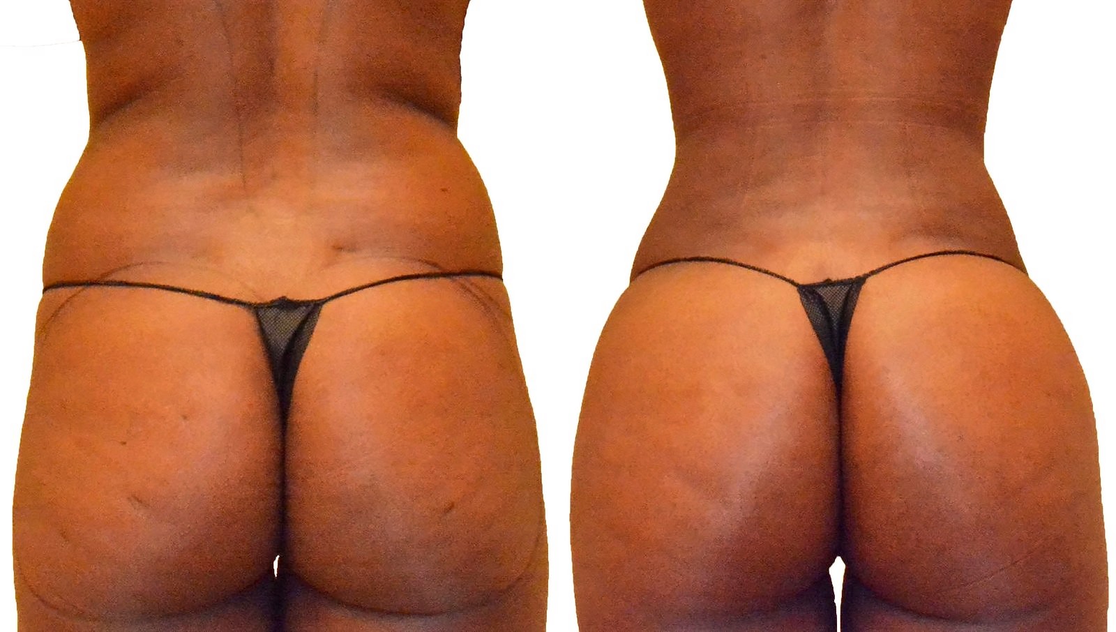 Before/After Fat Transfer, BBL before and after, actual patient of Dr. Long