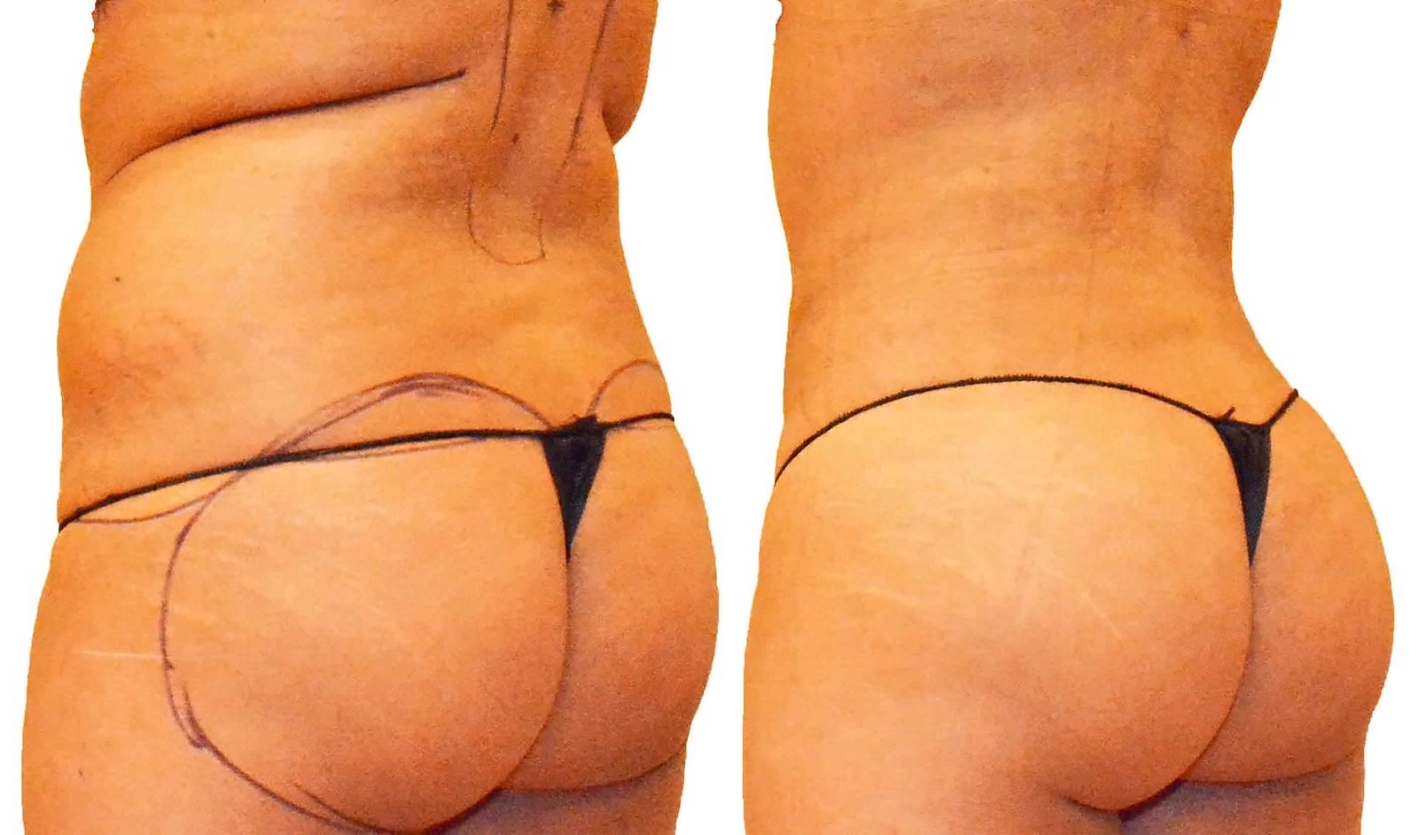 Before/After Fat Transfer, BBL before and after, actual patient of Dr. Long