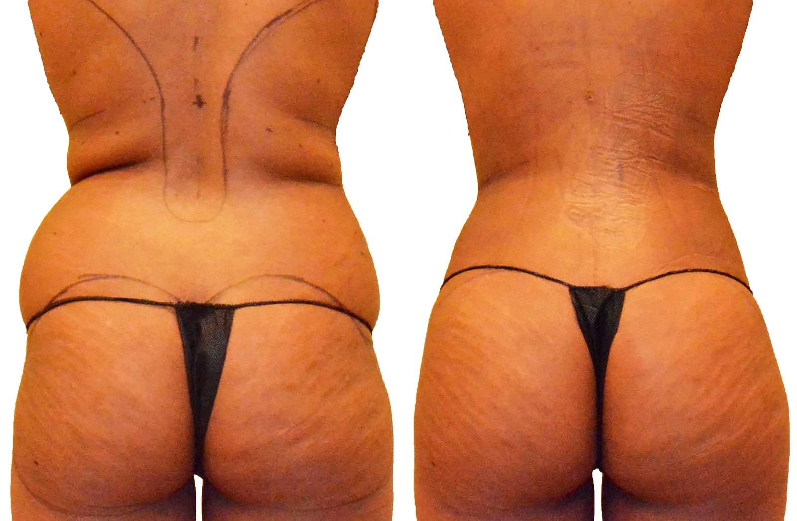 Before/After Fat Transfer, BBL before and after, actual patient of Dr. Long