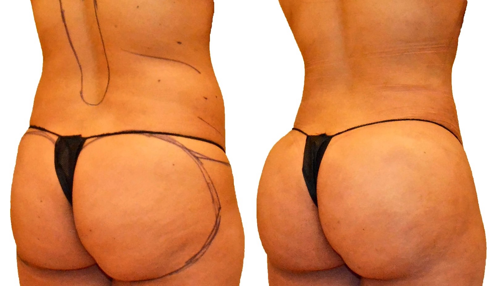 Before/After Fat Transfer, BBL before and after, actual patient of Dr. Long