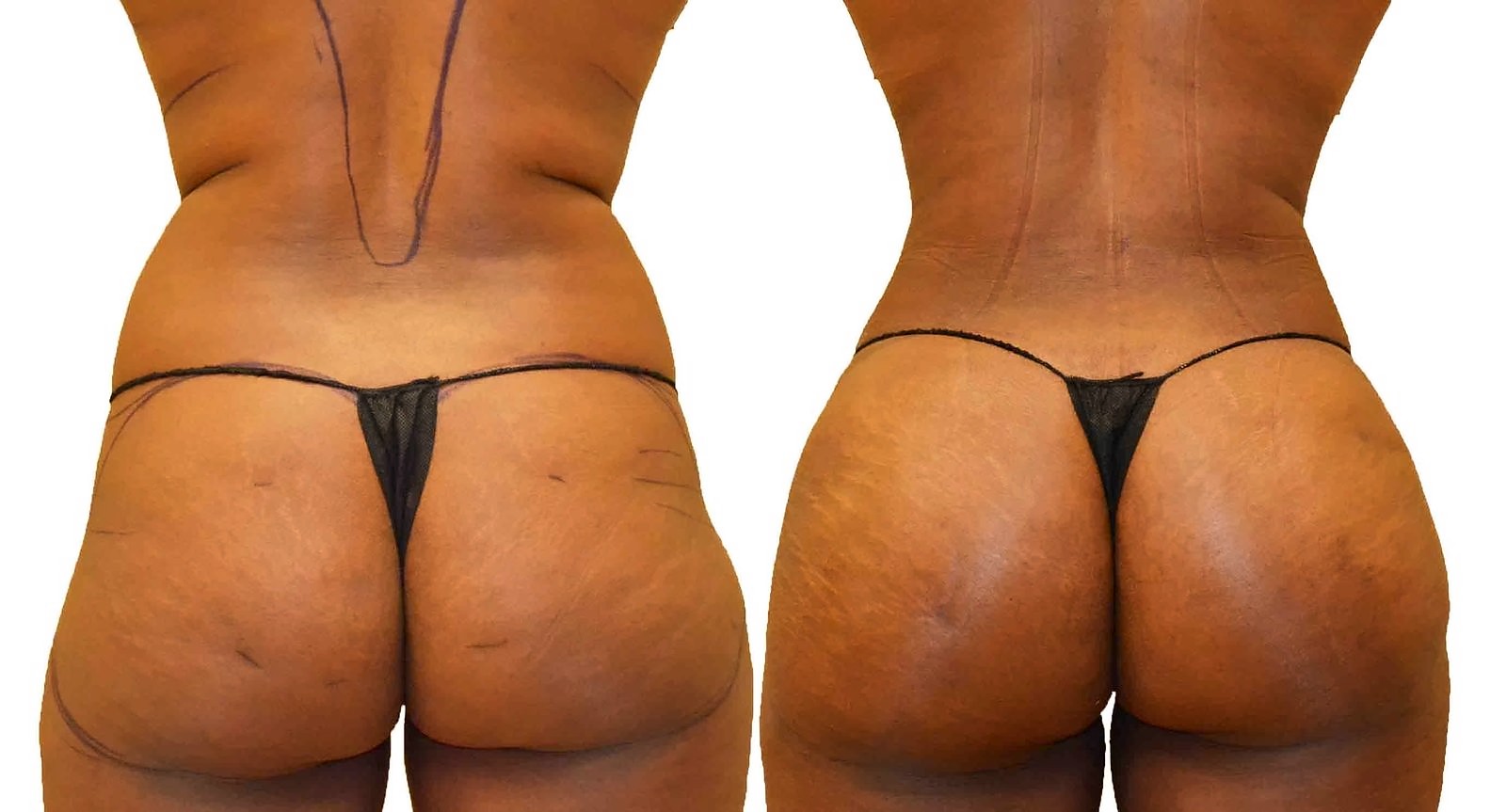 Before/After Fat Transfer, BBL before and after, actual patient of Dr. Long