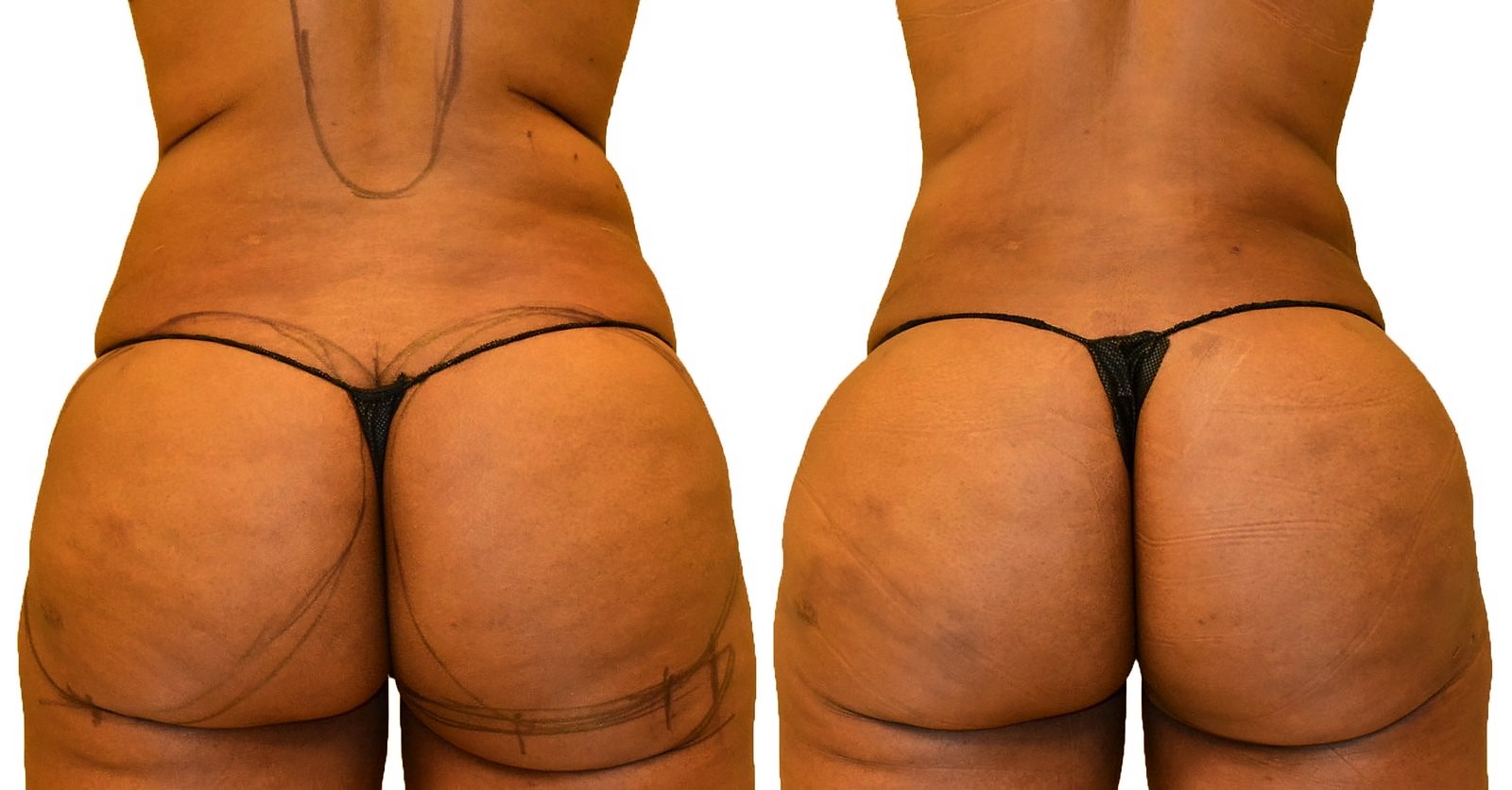 Before/After Fat Transfer, BBL before and after, actual patient of Dr. Long