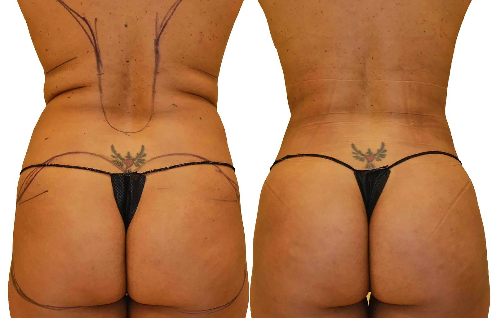 Before/After Fat Transfer, BBL before and after, actual patient of Dr. Long
