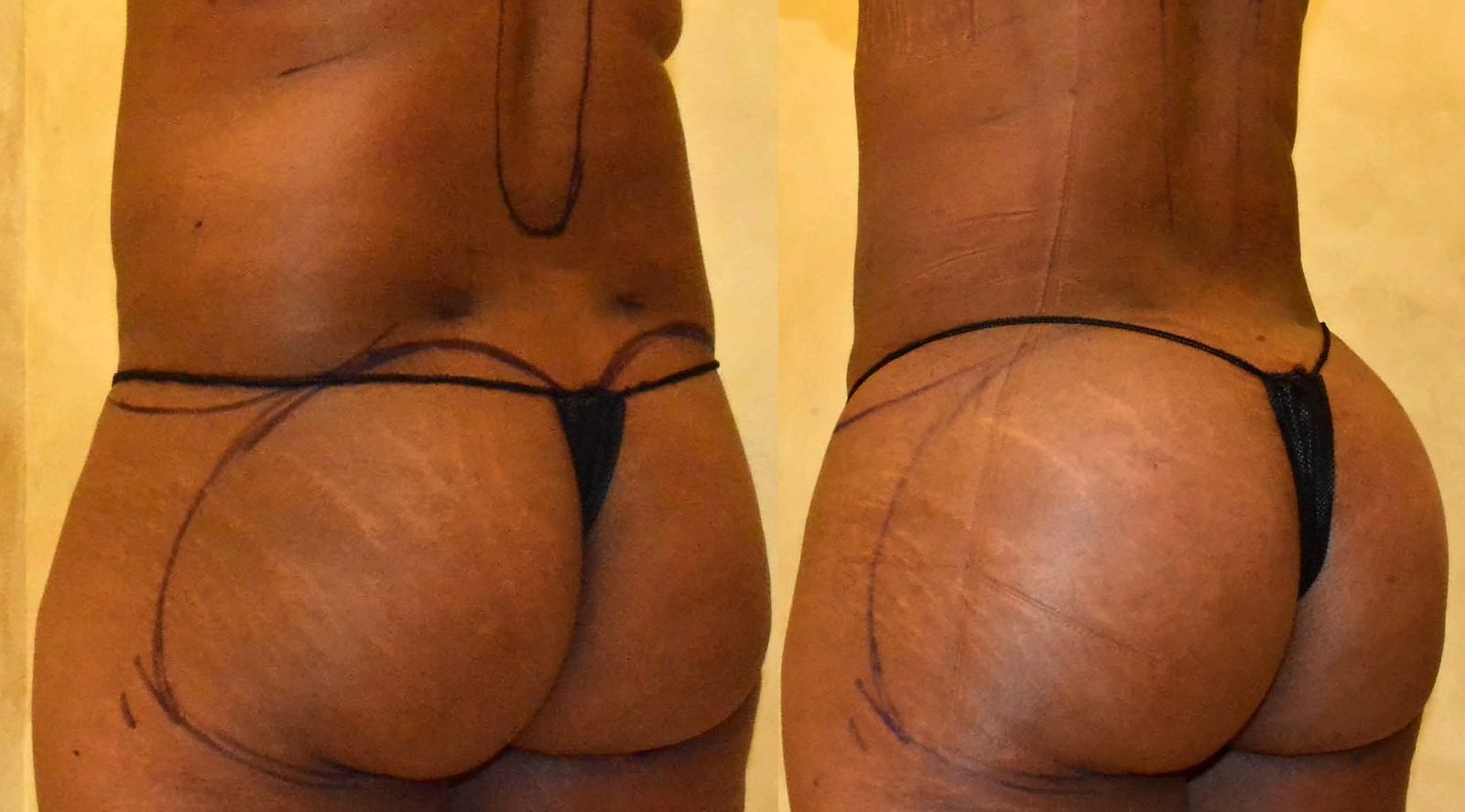 Before/After Fat Transfer, BBL before and after, actual patient of Dr. Long