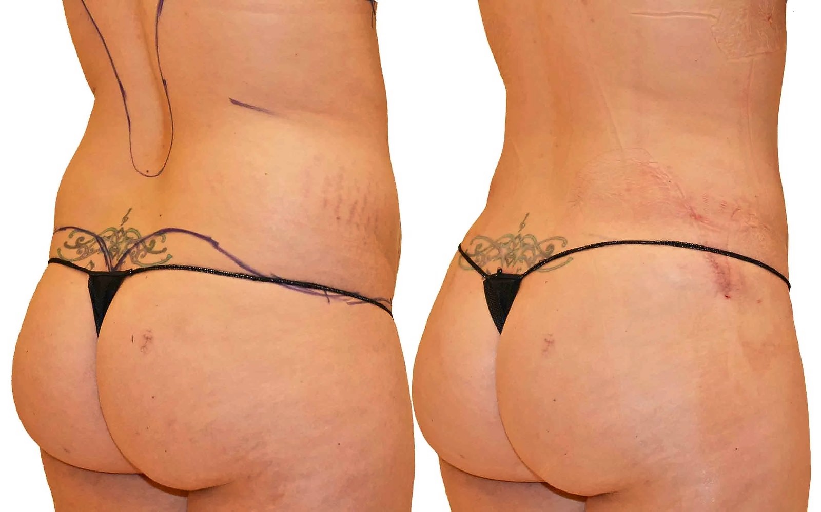 Before/After Fat Transfer, BBL before and after, actual patient of Dr. Long
