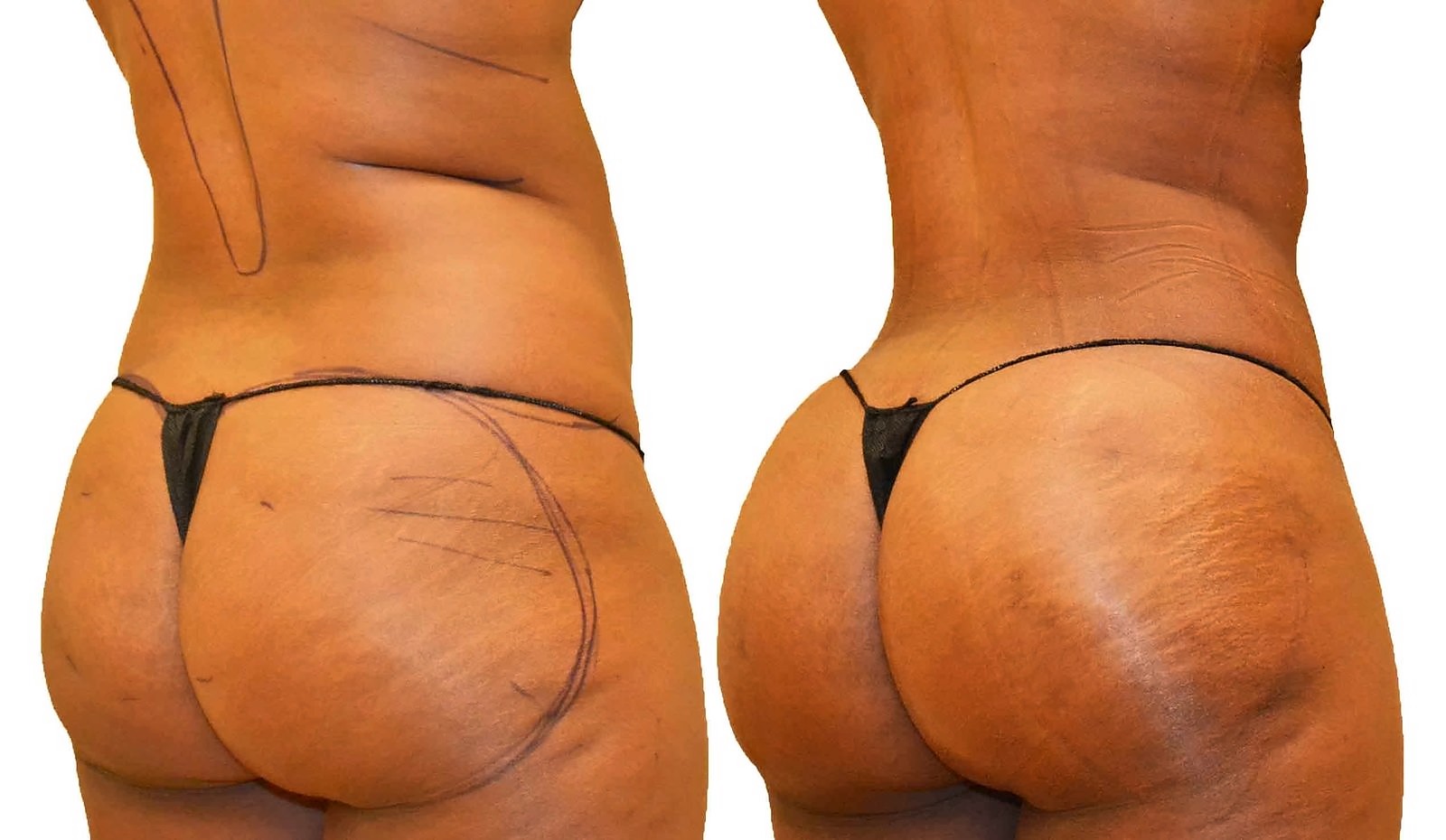 Before/After Fat Transfer, BBL before and after, actual patient of Dr. Long