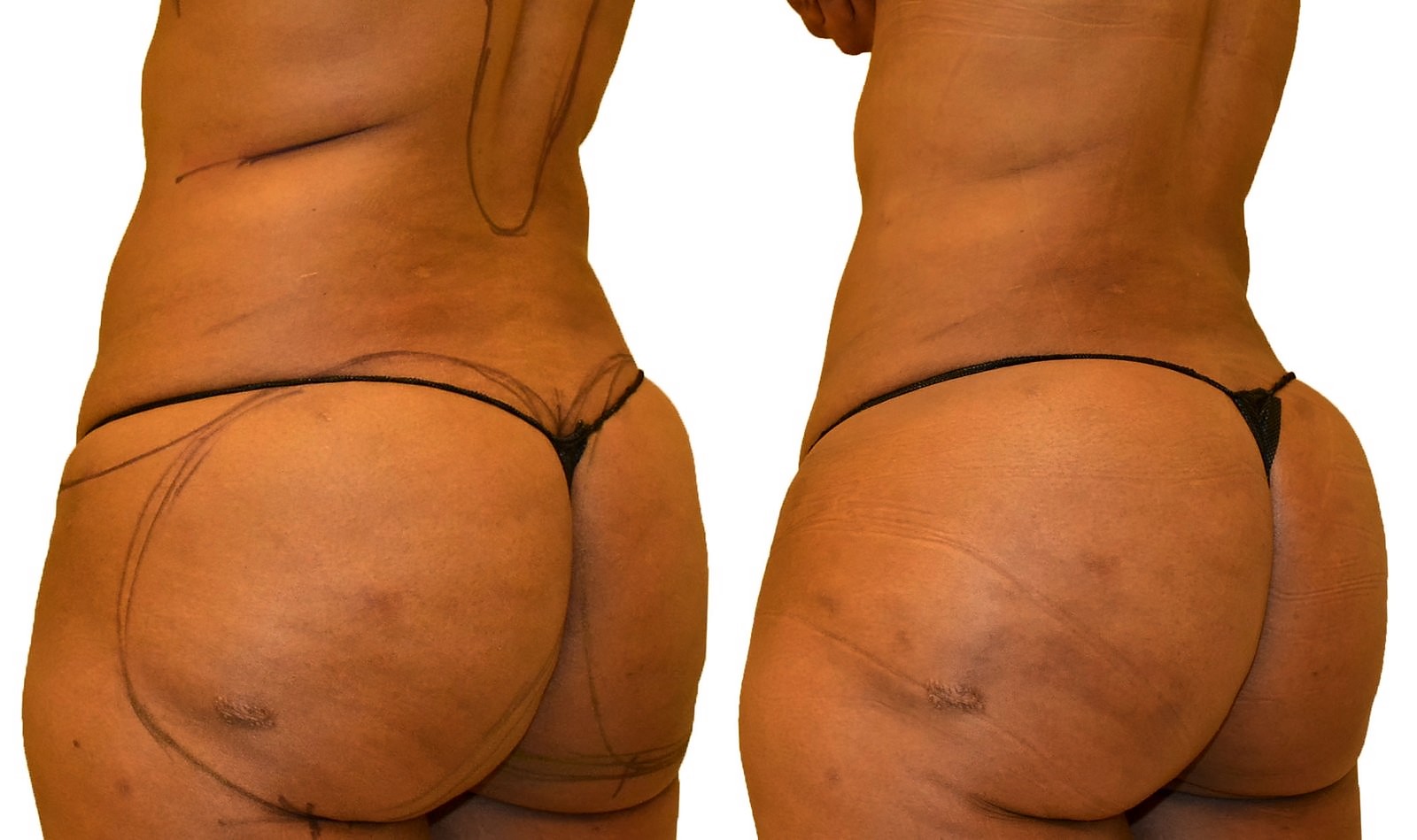 Before/After Fat Transfer, BBL before and after, actual patient of Dr. Long