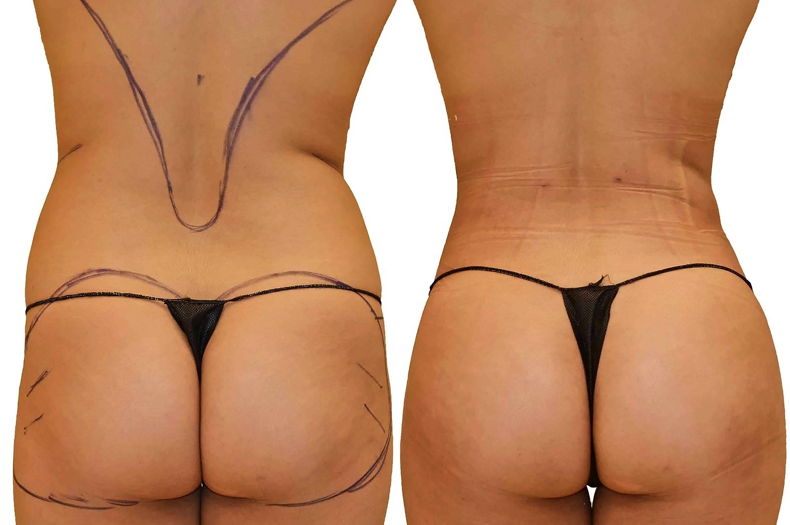 Before/After Fat Transfer, BBL before and after, actual patient of Dr. Long