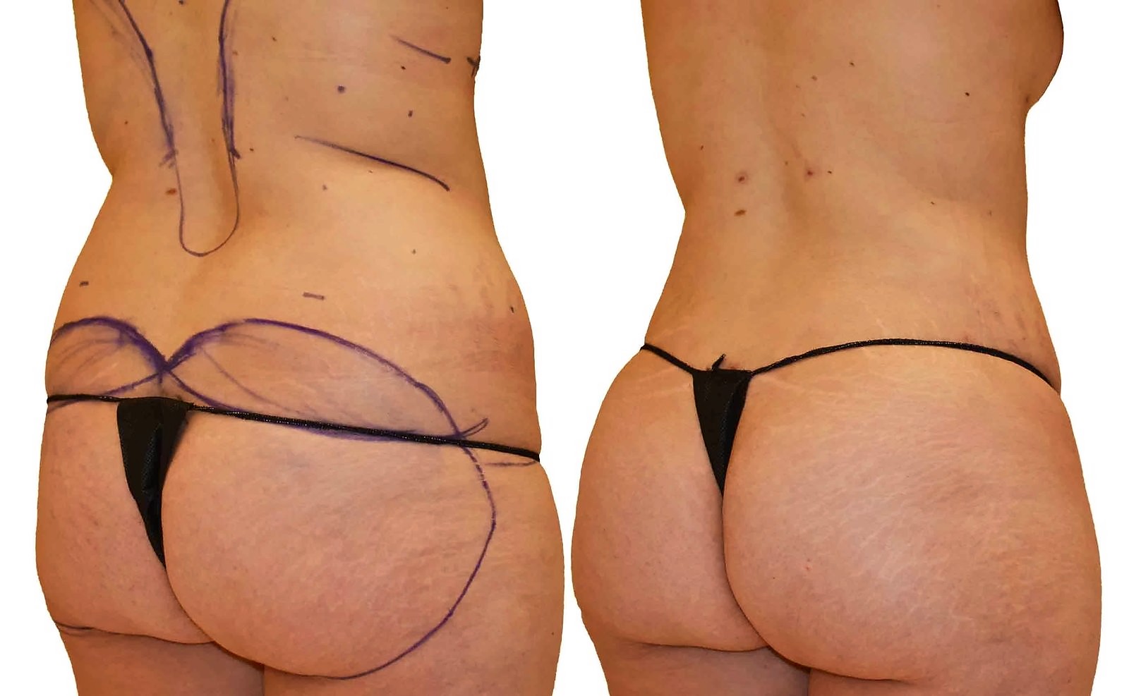 Before/After Fat Transfer, BBL before and after, actual patient of Dr. Long