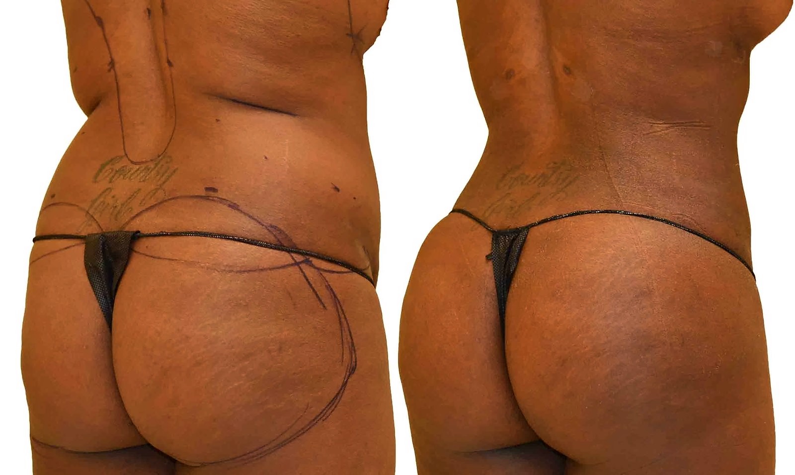 Before/After Fat Transfer, BBL before and after, actual patient of Dr. Long