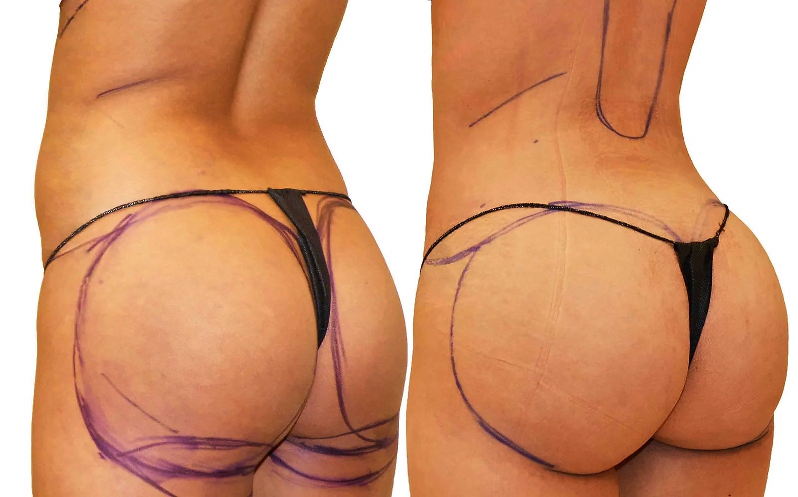 Before/After Fat Transfer, BBL before and after, actual patient of Dr. Long