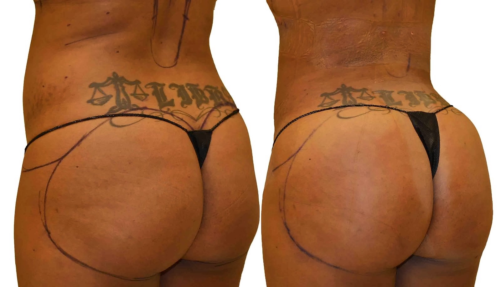 Before/After Fat Transfer, BBL before and after, actual patient of Dr. Long