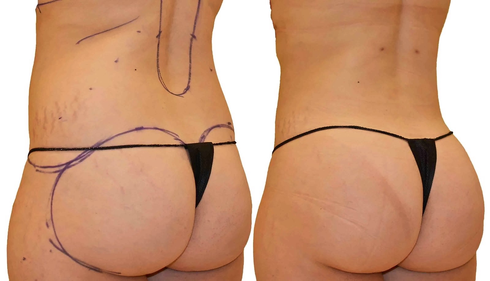 Before/After Fat Transfer, BBL before and after, actual patient of Dr. Long