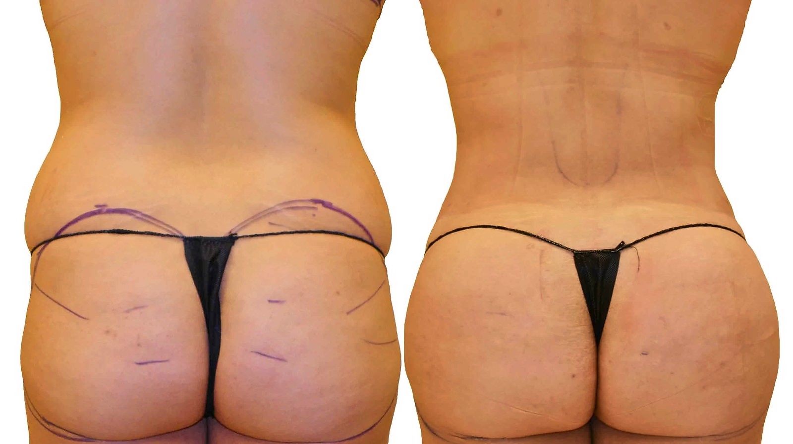 Before/After Fat Transfer, BBL before and after, actual patient of Dr. Long