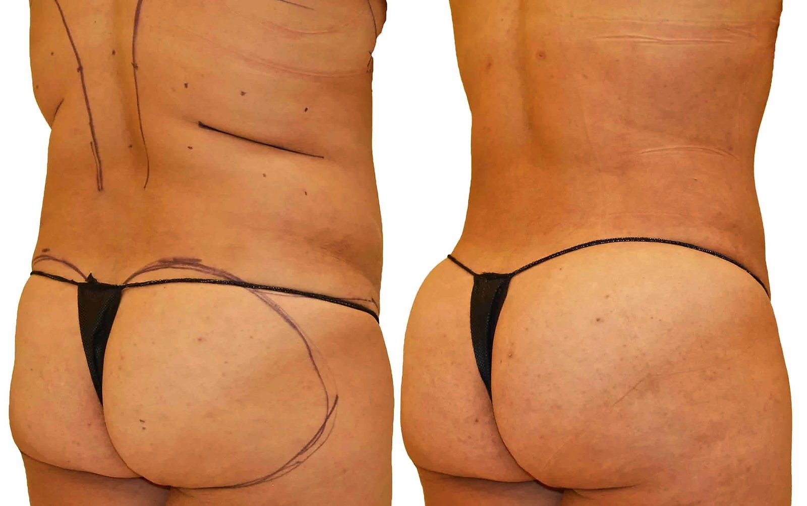 Before/After Fat Transfer, BBL before and after, actual patient of Dr. Long