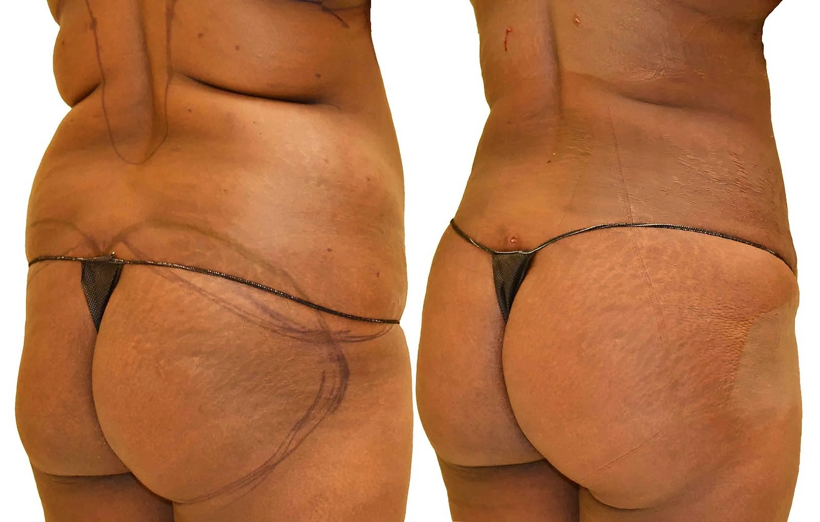 Before/After Fat Transfer, BBL before and after, actual patient of Dr. Long