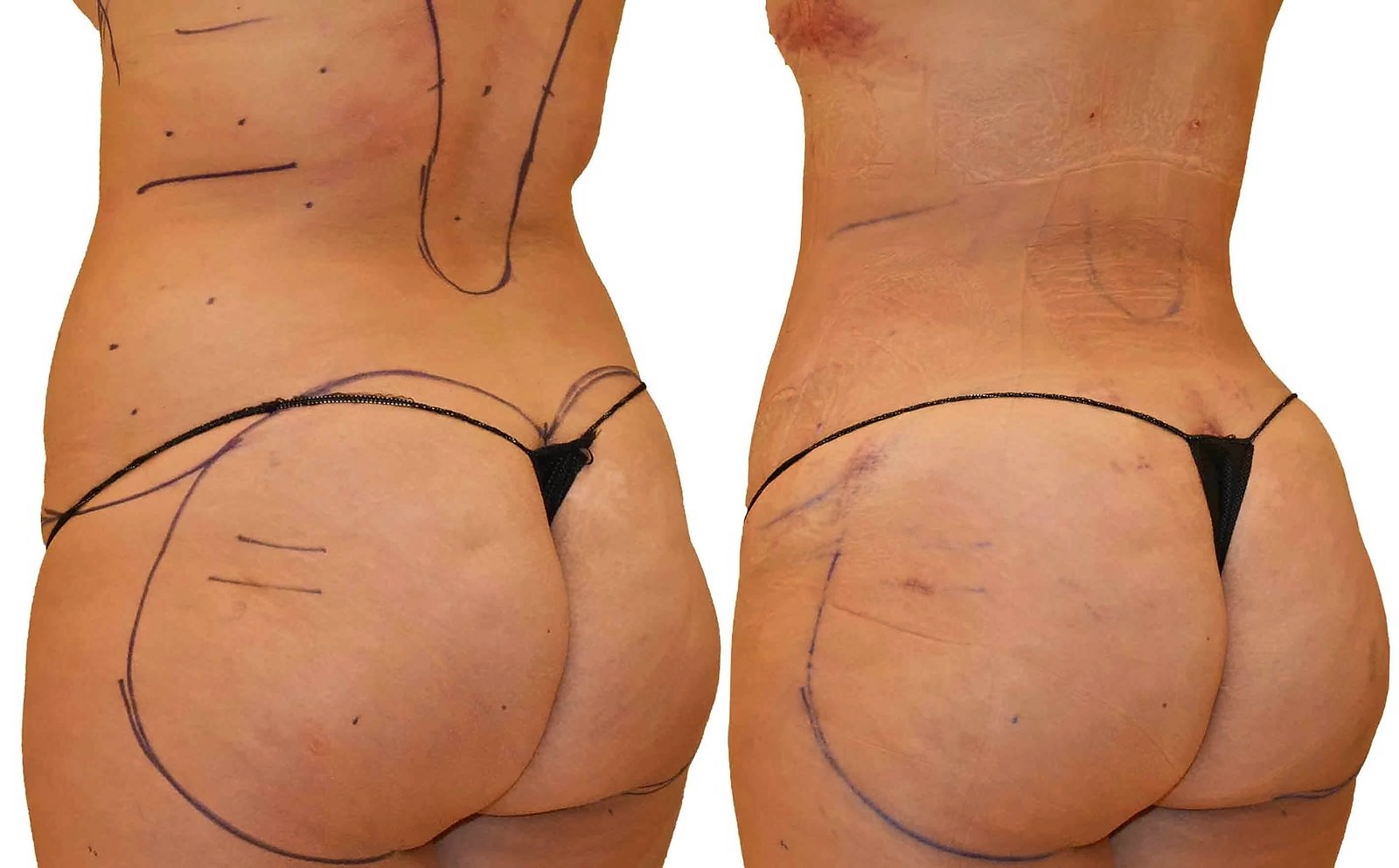 Before/After Fat Transfer, BBL before and after, actual patient of Dr. Long