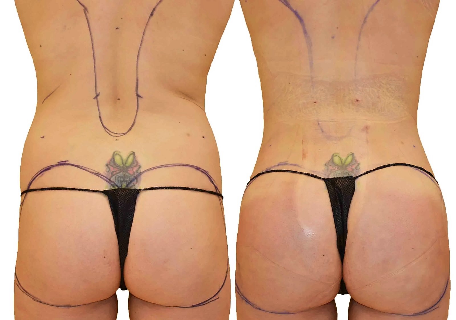 Before/After Fat Transfer, BBL before and after, actual patient of Dr. Long