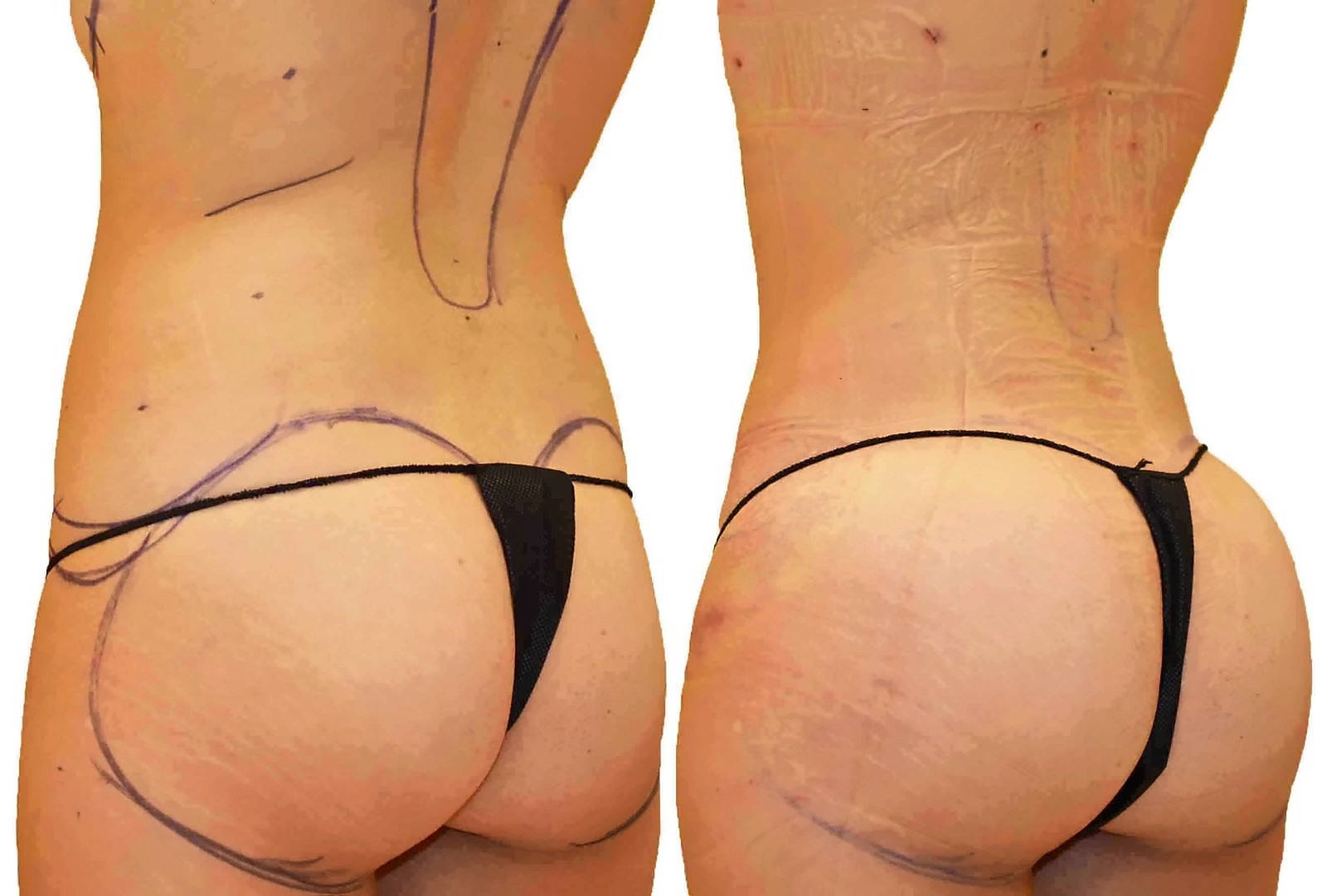 Before/After Fat Transfer, BBL before and after, actual patient of Dr. Long